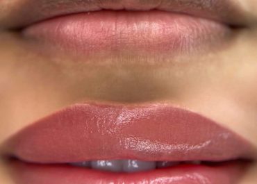 Dark Lip Neutralization in Dubai for Dark and Uneven Lips